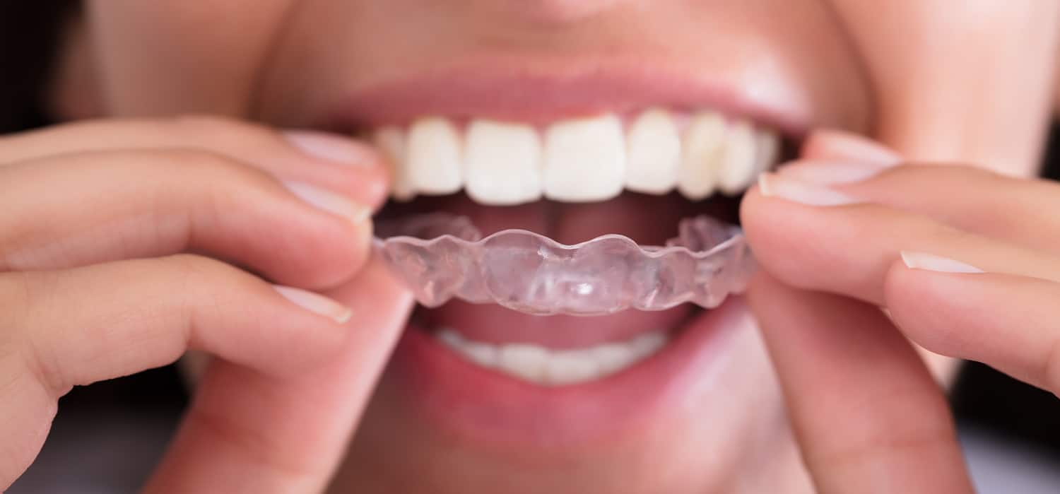 clear aligners in Raleigh