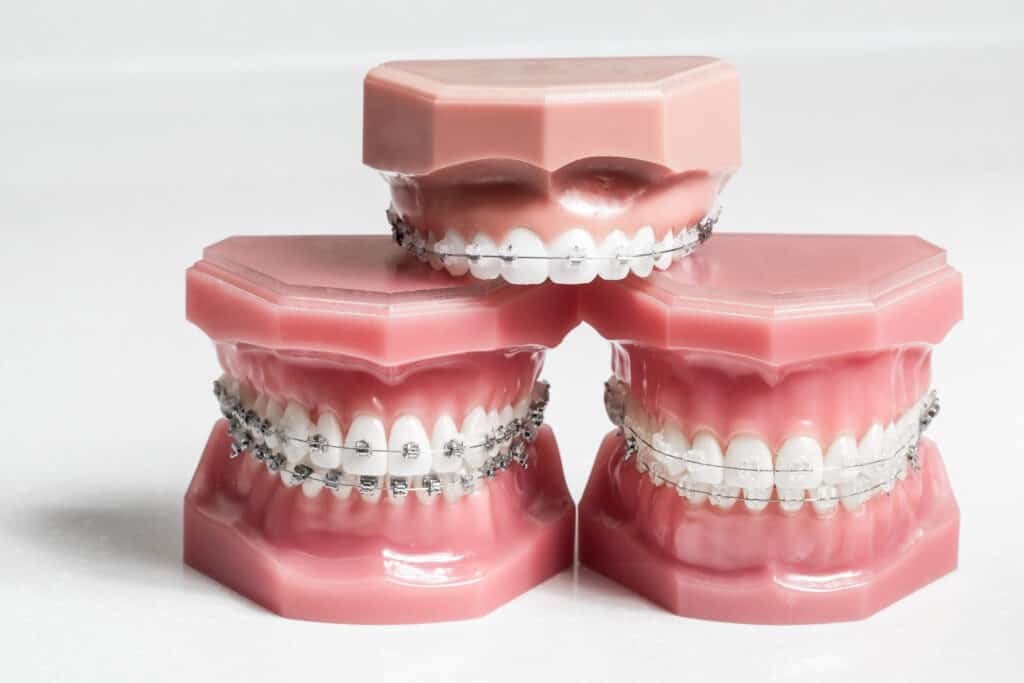 Three model jaws with wire braces stacked, example of dental and orthodontic technology for teeth alignment