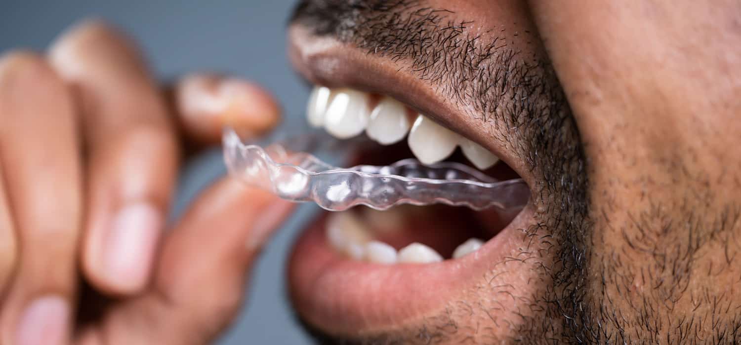 can-you-get-invisible-aligners-with-missing-teeth-orthodontist