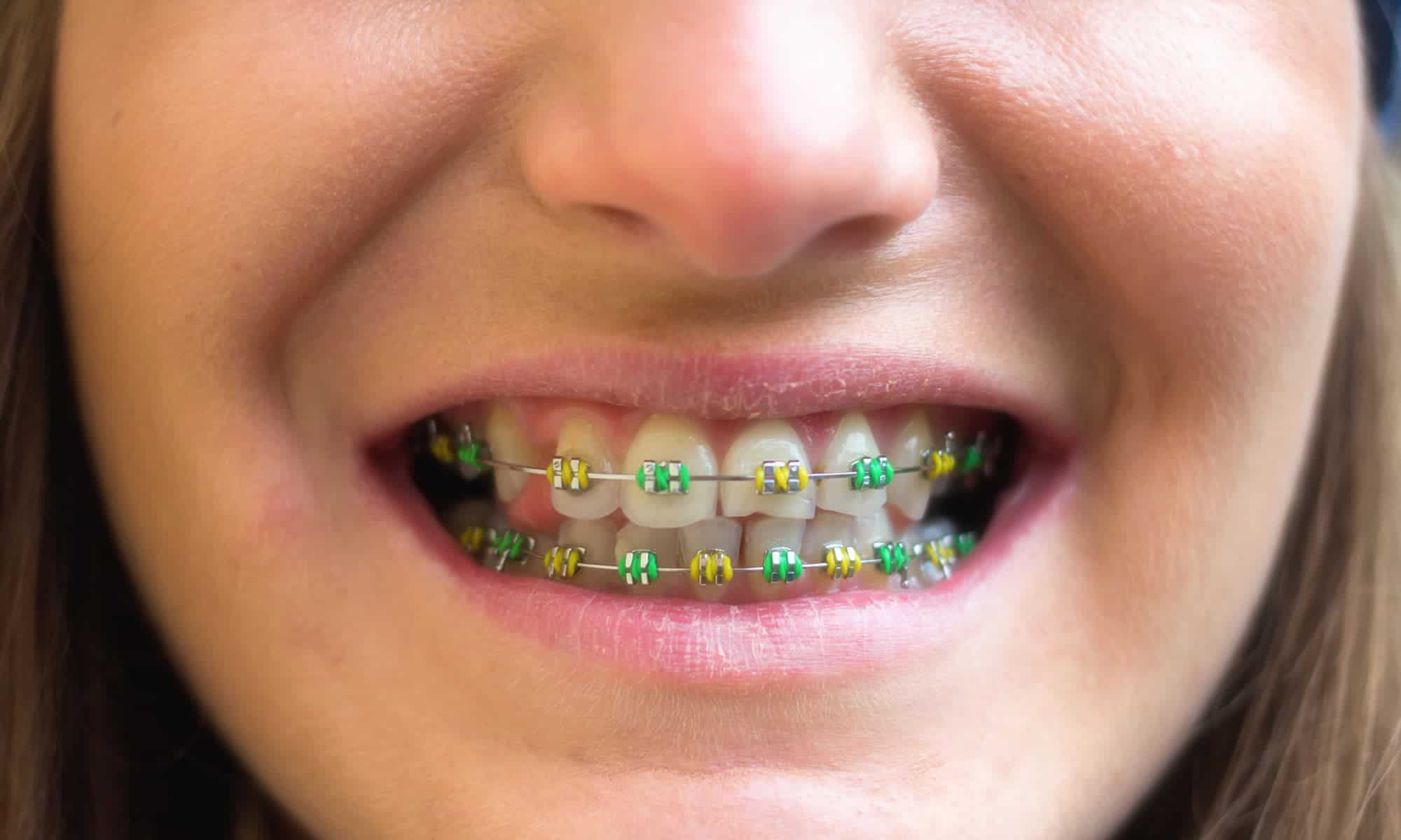 Things to Remember When Wearing Dental Braces - Vistadent